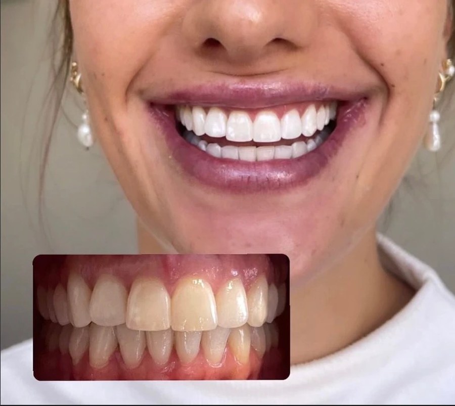 Sourire avant/après blanchiment dentaire, client NG BEAUTY